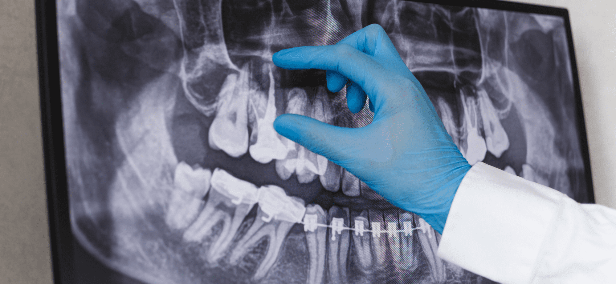 Root Canals Emergency Denstistry services in Crown Point Indiana