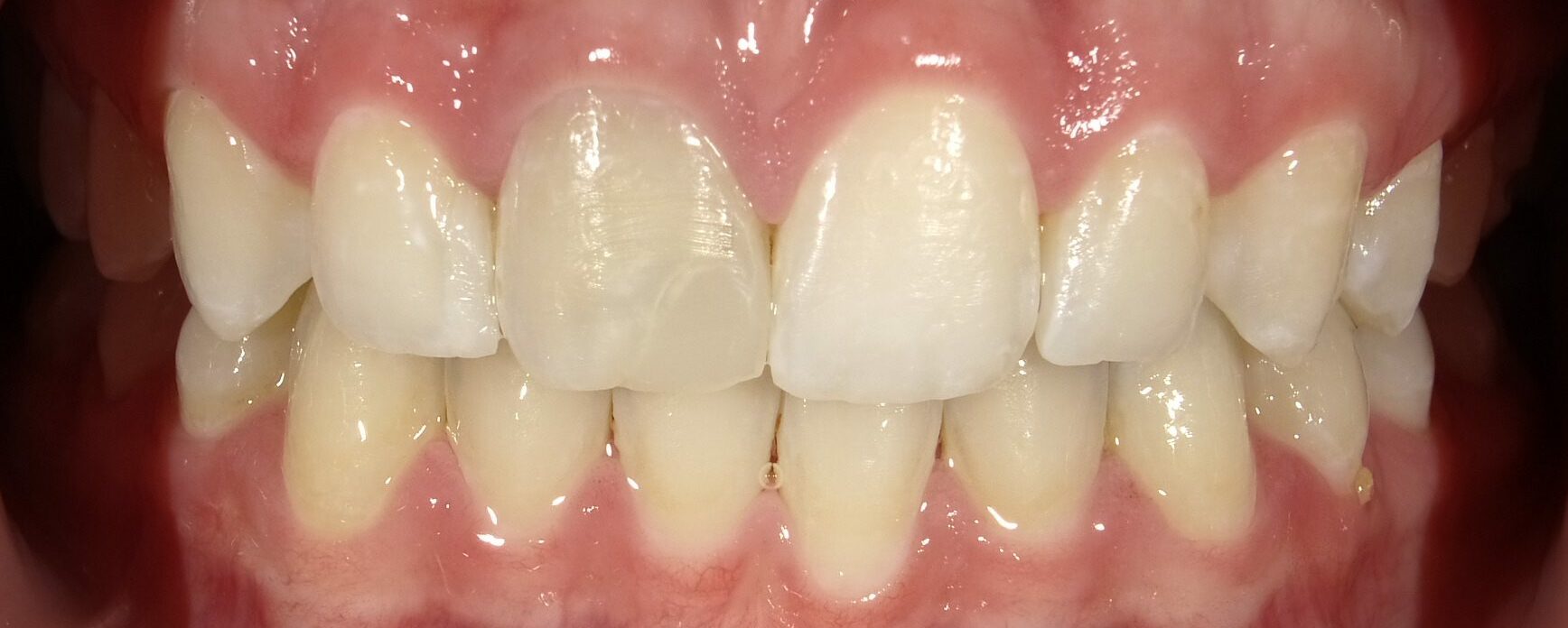 Dental Crowns Before &amp; After