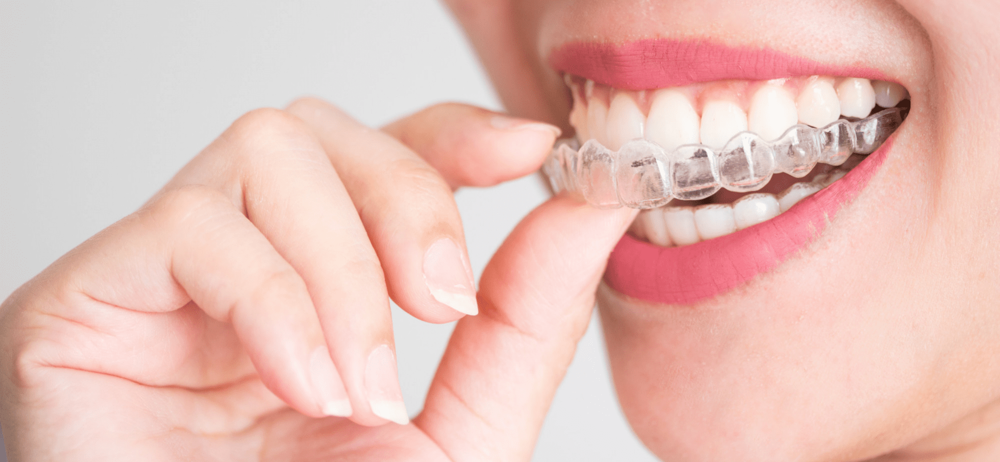 Cost of invisalign in indiana