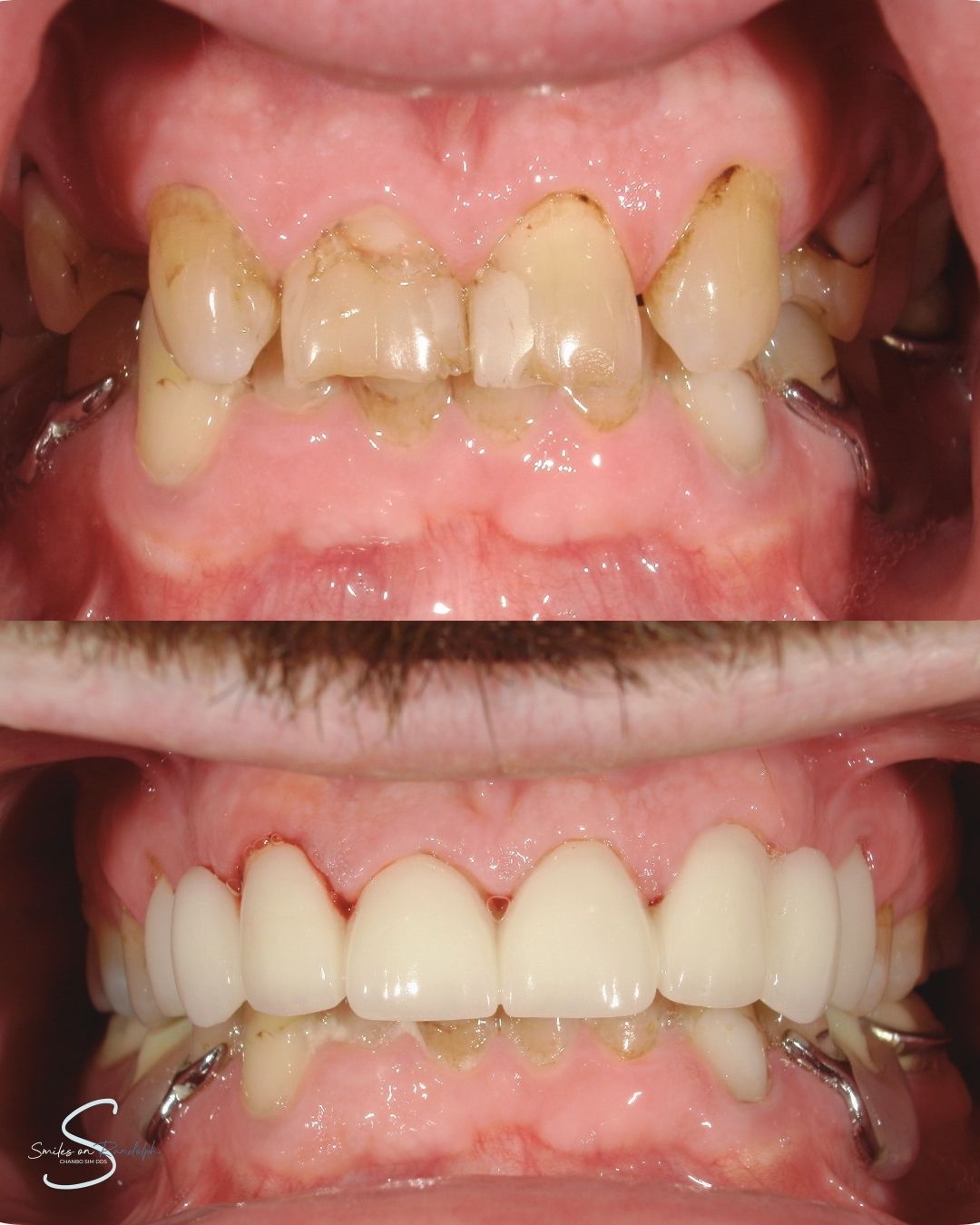 Dental Bridges