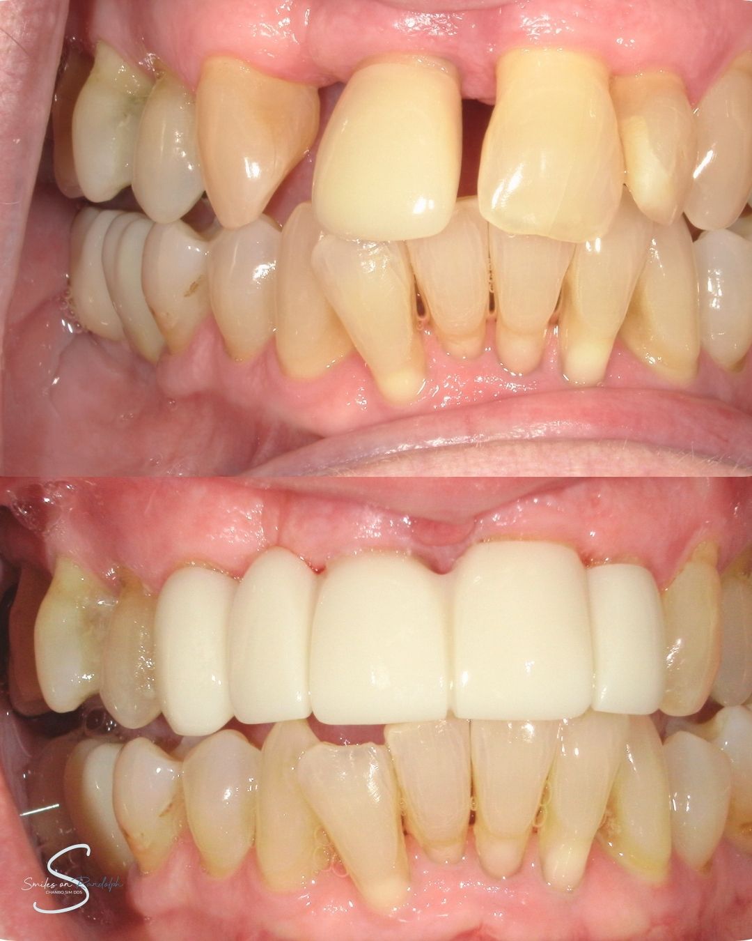 Dental Bridges