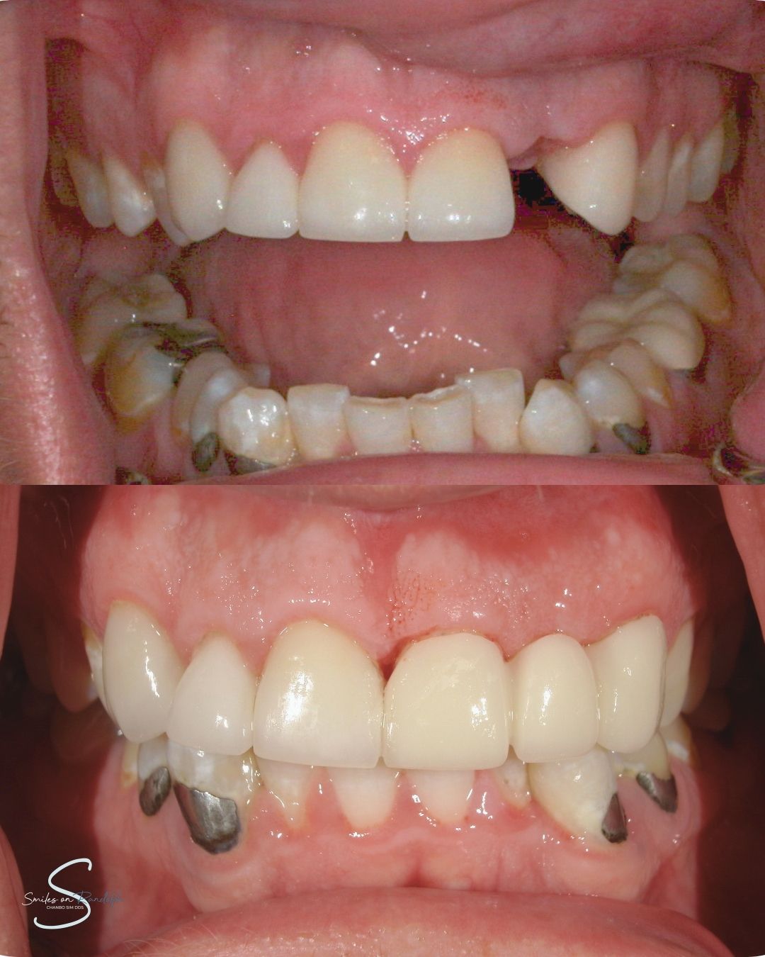 Dental Crowns