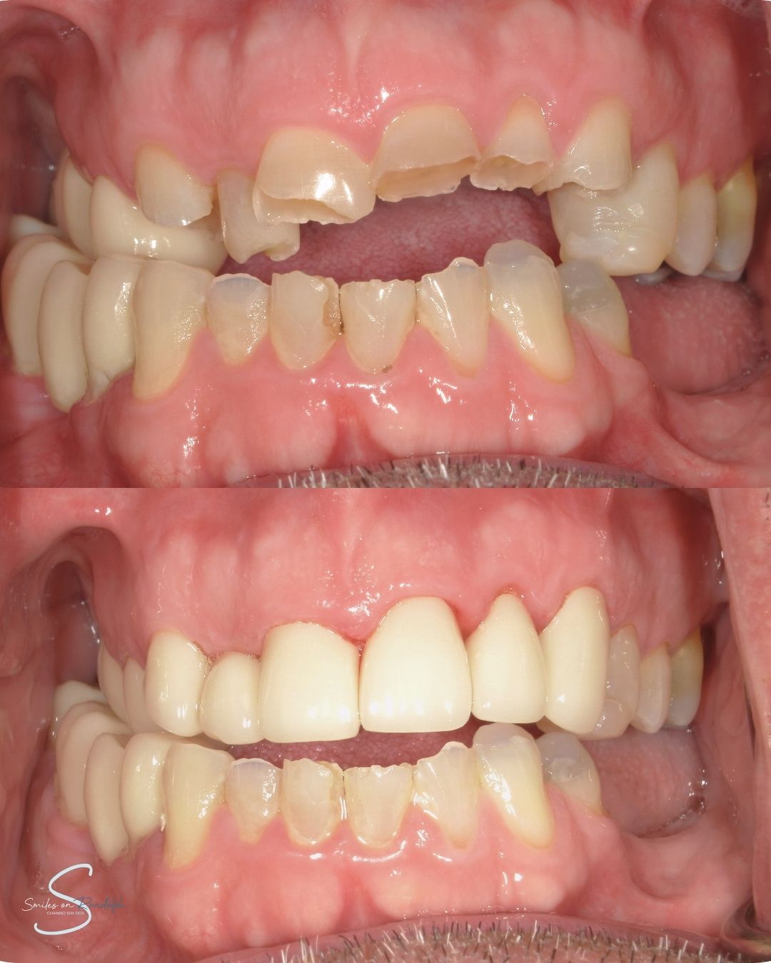 Dental Crowns